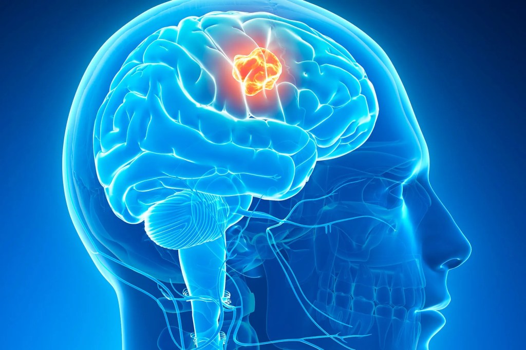 The Relationship between Psychiatric Disorders and Brain&nbsp;Tumors